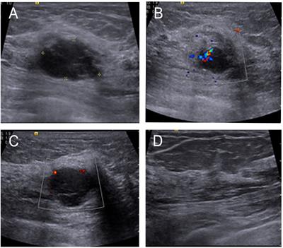 Primary Giant Cell Tumor of the Breast With Pulmonary Metastasis: A Case Report and Review of the Literature